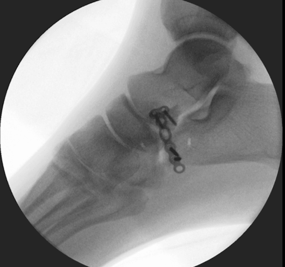 Lateral intra-operative fluoroscopic view after anterior-process locking-plate fixation