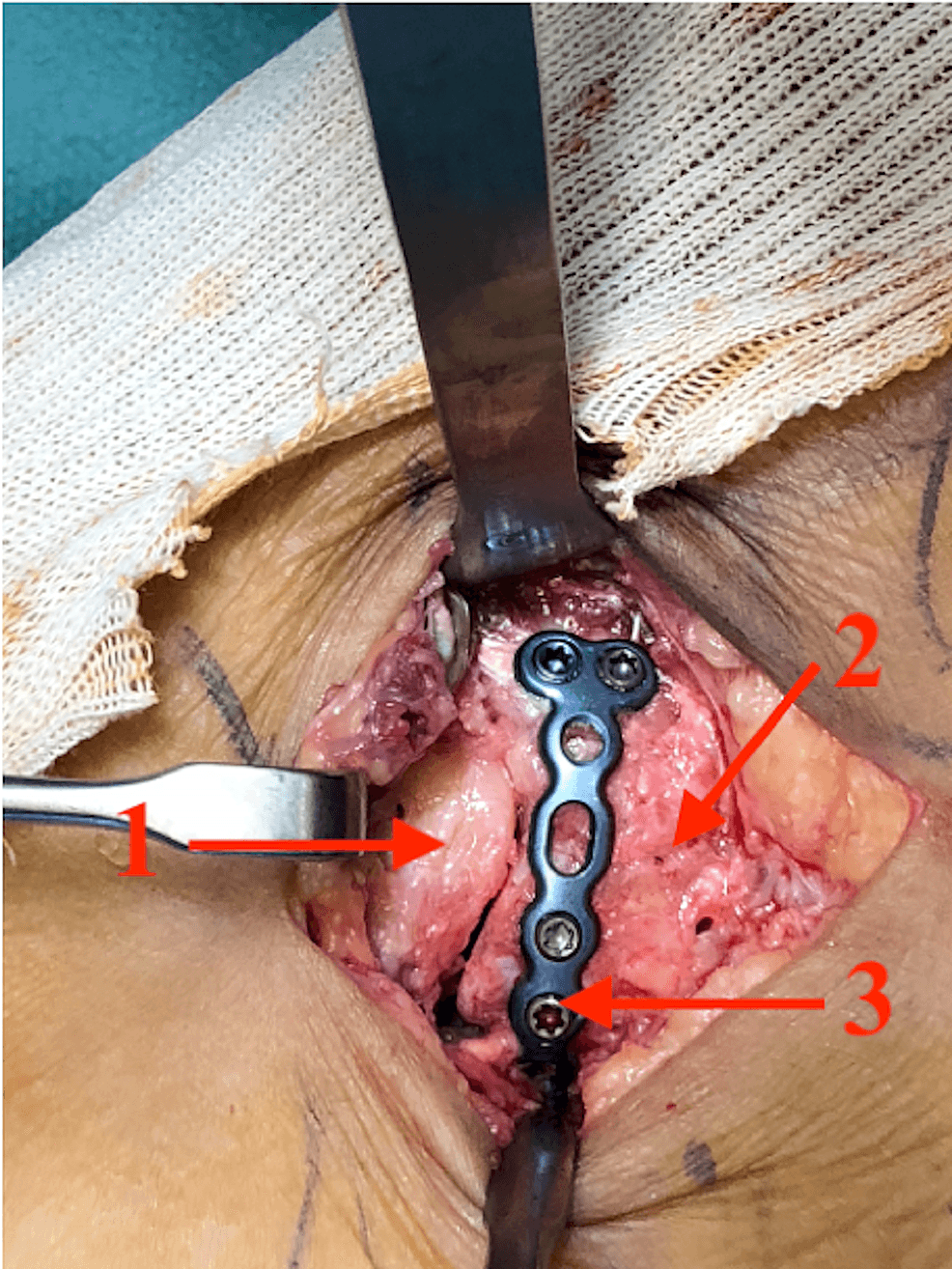 Operative view of locking T-plate fixation of a reduced anterior-process fracture