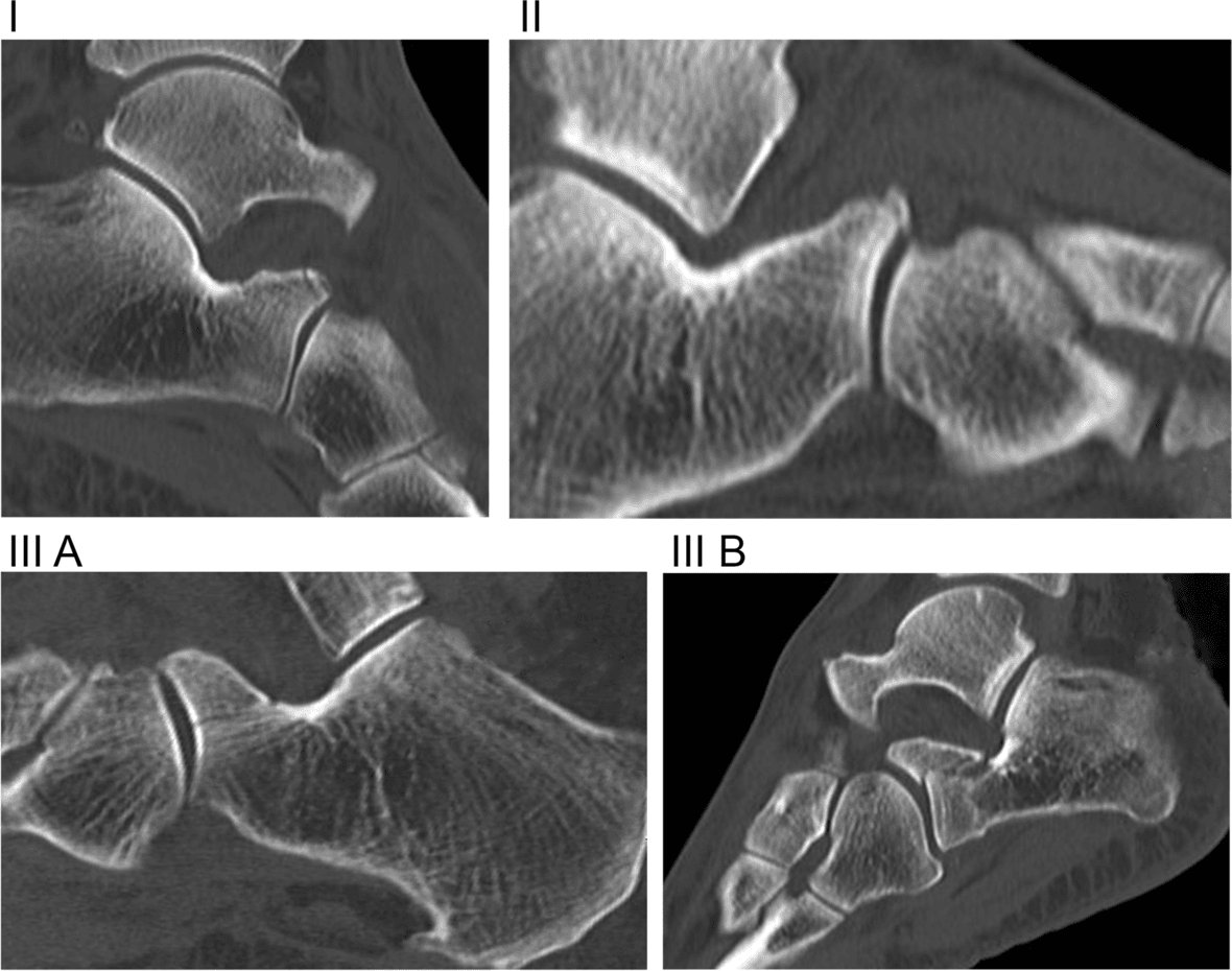 Four sagittal CT images showing modified Degan anterior-process fracture types I, II, IIIA and IIIB
