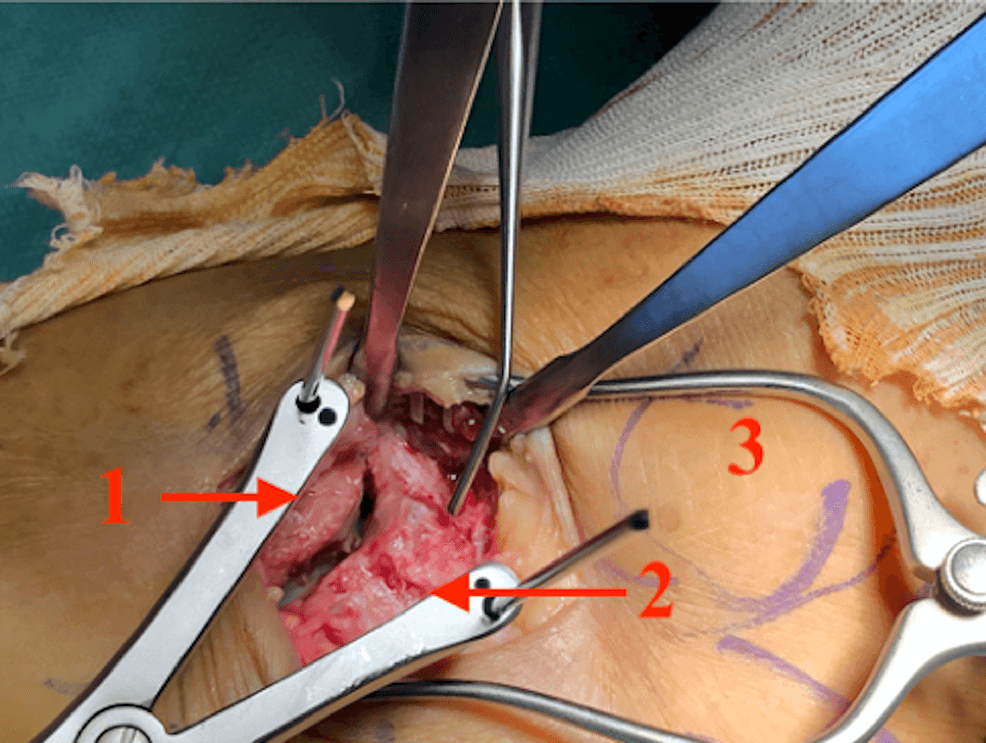 Operative lateral exposure of the cuboid and anterior-process fracture line