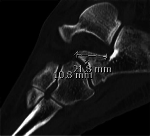 CT sagittal measurement of anterior process fracture fragment