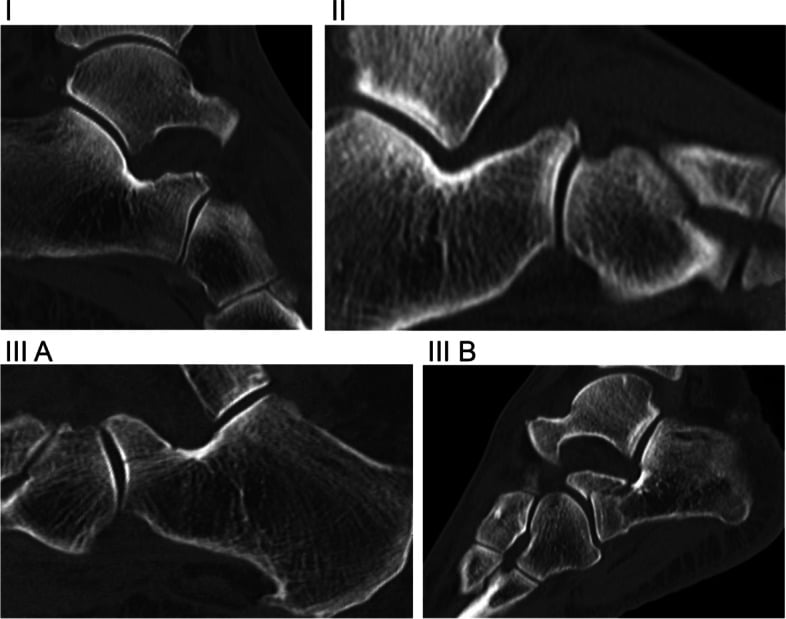 Modified Degan Classification of anterior process calcaneus fractures