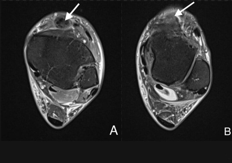 Two axial MR images of the ankle, labelled A and B, with arrows at the tibialis anterior position