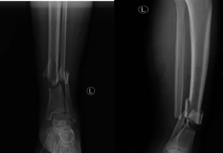 AP and lateral radiographs of the left leg showing a fracture of the distal tibia and fibula