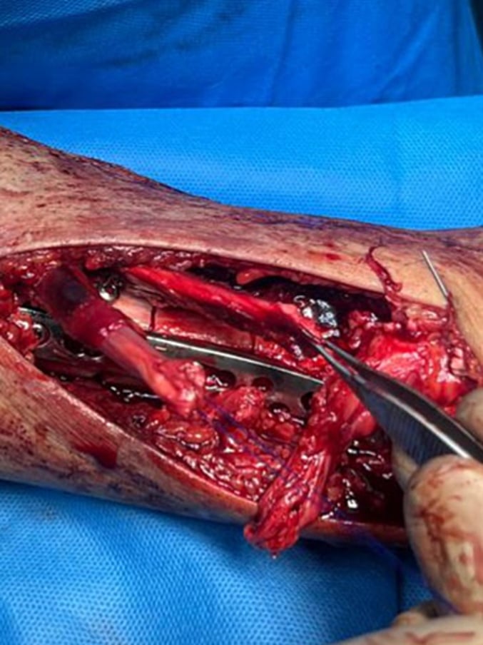 Operative exposure of the anterior leg showing divided tendon stumps beside a plated tibial fracture, one stump held in forceps