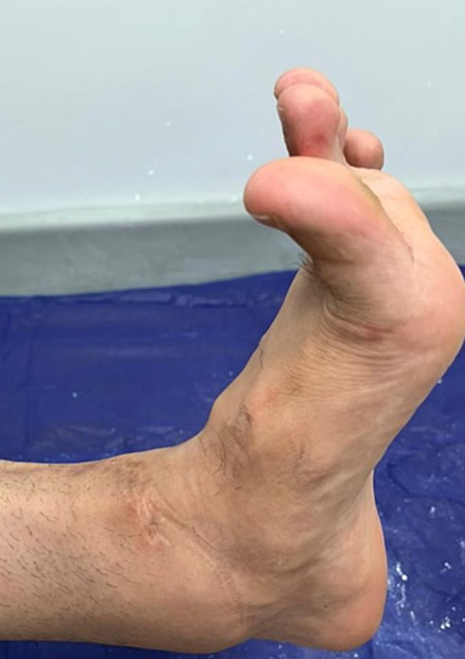 Clinical photograph at follow-up showing the ankle dorsiflexed, the great toe extended and a healed scar over the anterior ankle