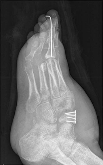 Oblique postoperative foot radiograph showing a small plate with four screws at the medial cuneiform and a longitudinal wire along the hallux