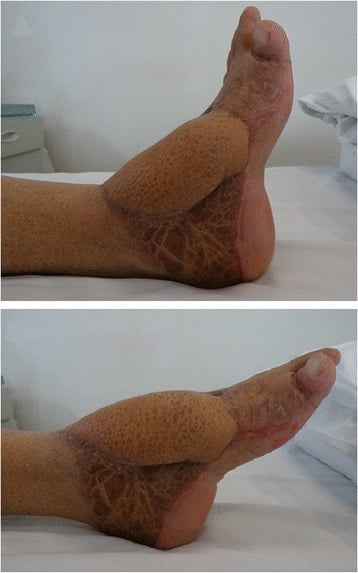 Two clinical photographs of a healed anterolateral-thigh flap over the anterior ankle and dorsum of the foot, the ankle dorsiflexed in the upper image and plantarflexed in the lower