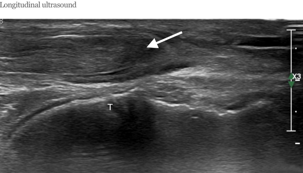 Longitudinal ultrasound of a ruptured tibialis anterior tendon showing a retracted, irregular proximal stump with a measured gap.