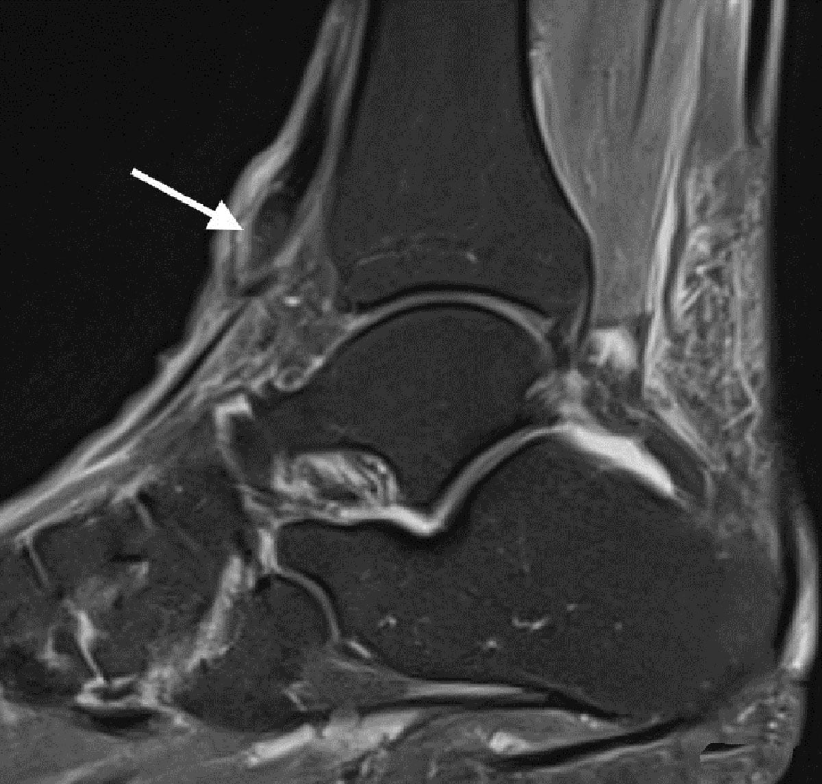 Sagittal fat-suppressed T2-weighted MRI of the ankle showing discontinuity of the tibialis anterior tendon just proximal to its insertion.