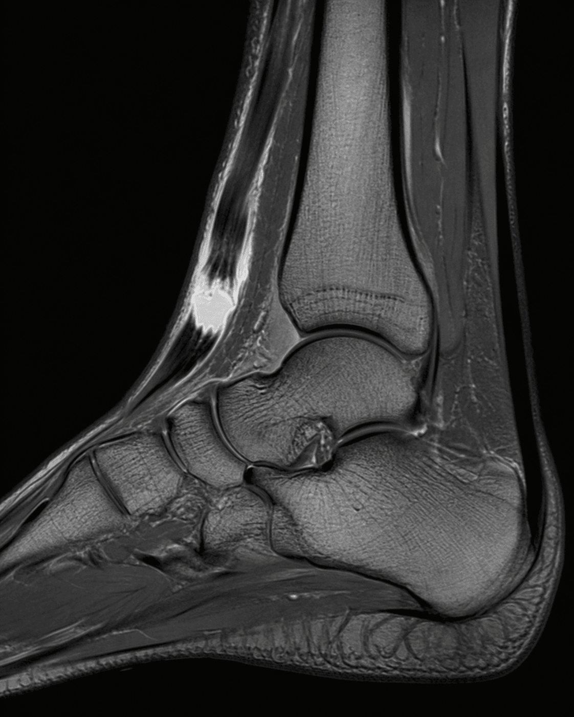 Sagittal ankle MRI showing discontinuity and retraction of the tibialis anterior tendon.