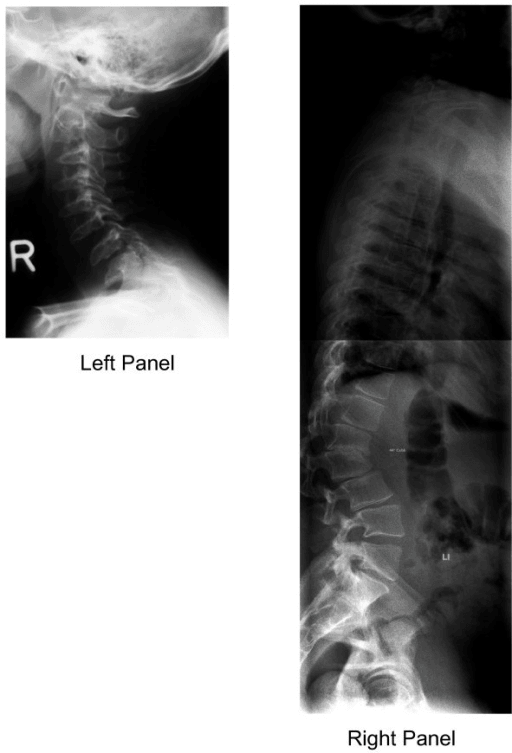 Lateral cervical spine X-ray with oval-shaped vertebral bodies due to deficient anterior ossification