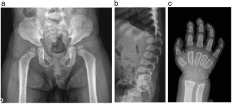 Paediatric radiographs showing flared iliac wings with tapered lower borders and a small hypoplastic L2 vertebral body