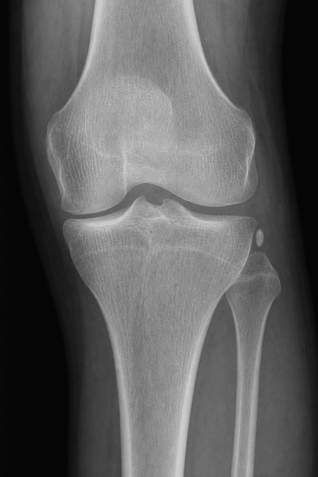 AP knee radiograph showing a small avulsion fragment off the lateral tibial plateau (Segond fracture)