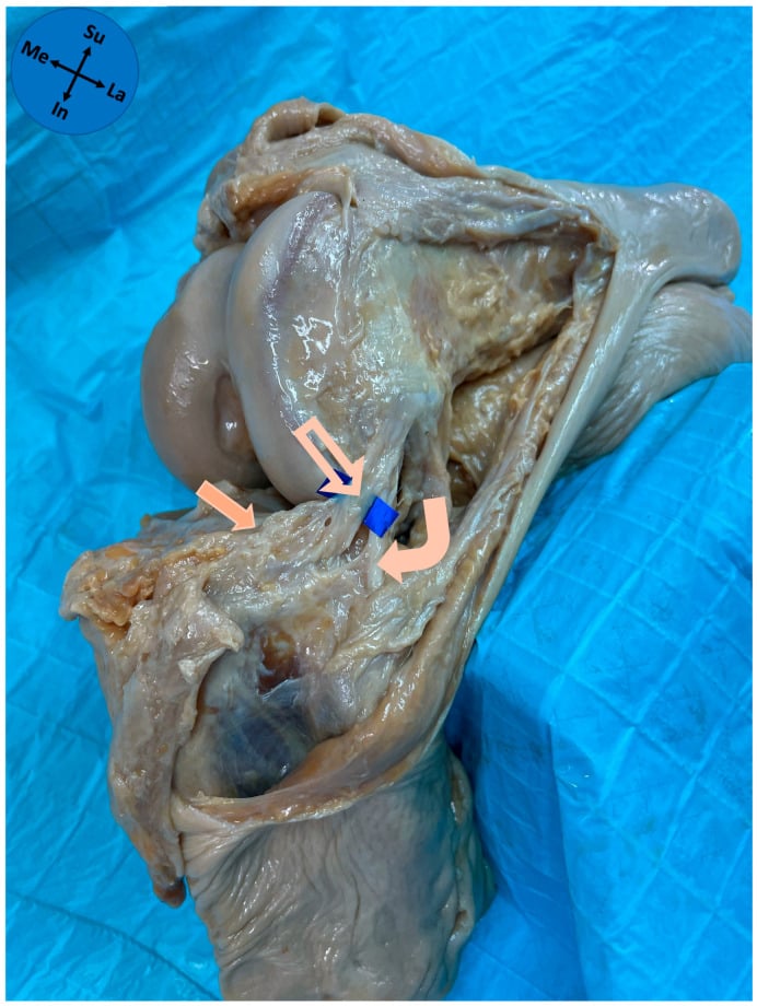Cadaveric anterolateral knee dissection identifying the ALL, lateral meniscus and fibular collateral ligament.