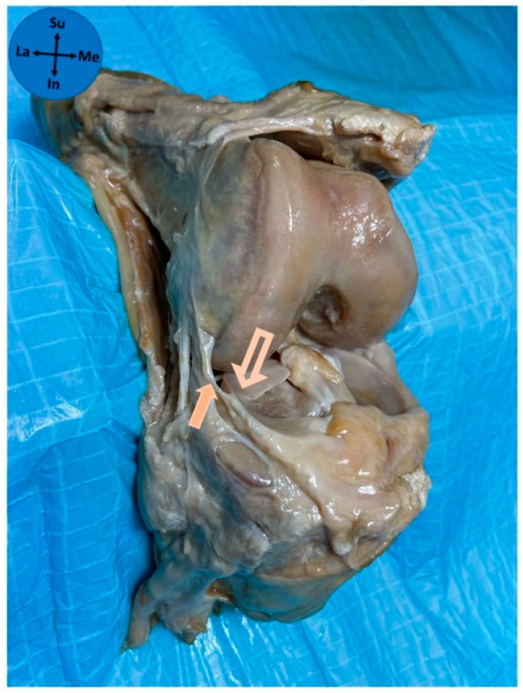 Cadaveric knee showing bipolar superior and inferior ALL attachments to the lateral meniscus.