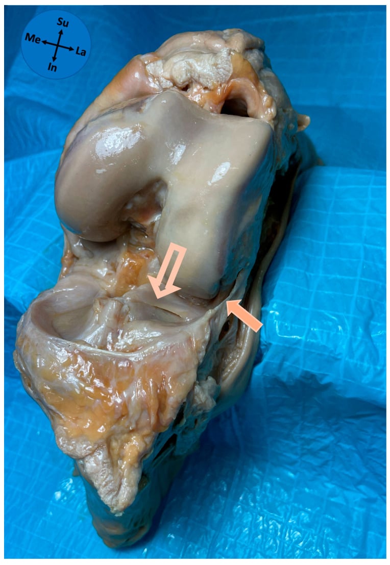 Cadaveric knee showing a full-thickness ALL attachment to the lateral meniscus.
