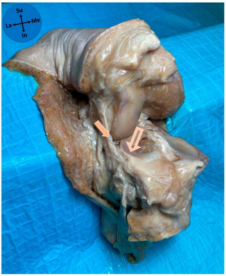 Cadaveric knee showing an inferior-type ALL attachment to the lateral meniscus.