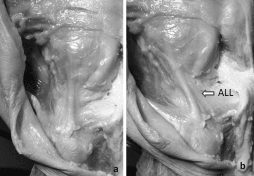 Paired cadaver photographs showing the ALL in neutral position and tightened by internal tibial rotation.