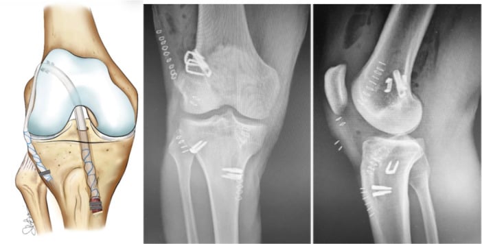 Schematic and postoperative knee radiographs of revision over-the-top ACL reconstruction with LET.