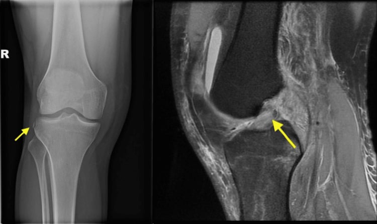 AP knee radiograph showing a Segond fragment with MRI confirming ACL and MCL rupture.