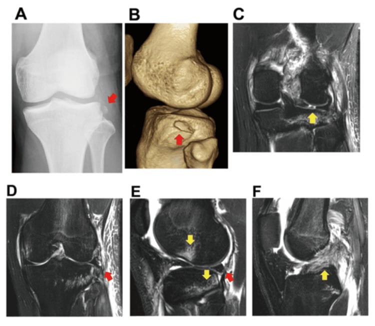 AP radiograph, three-dimensional CT and MRI showing a Segond fracture with lateral meniscal injury.