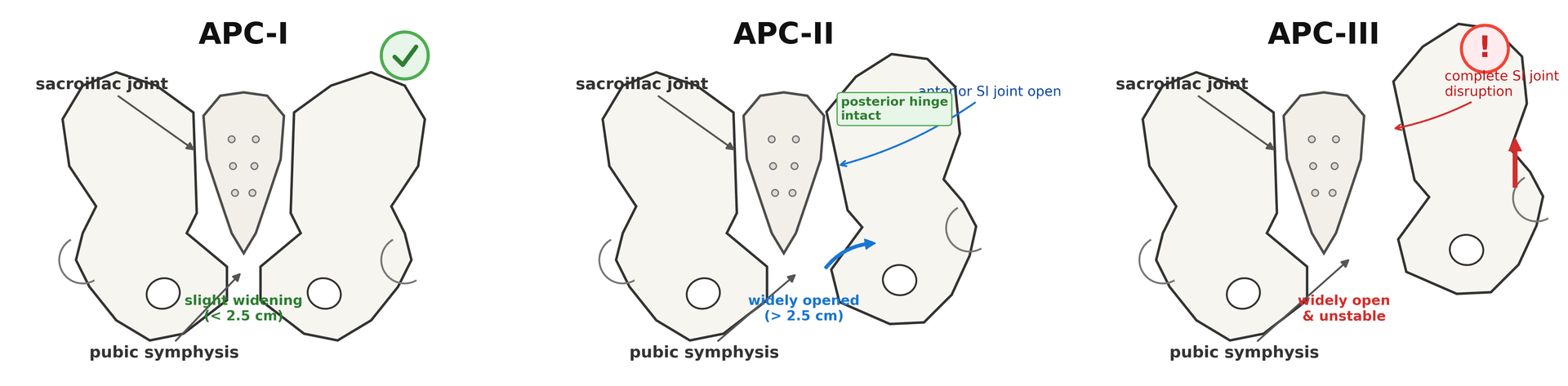 Diagram of the three Young-Burgess APC grades showing progressive symphysis widening and sacroiliac disruption
