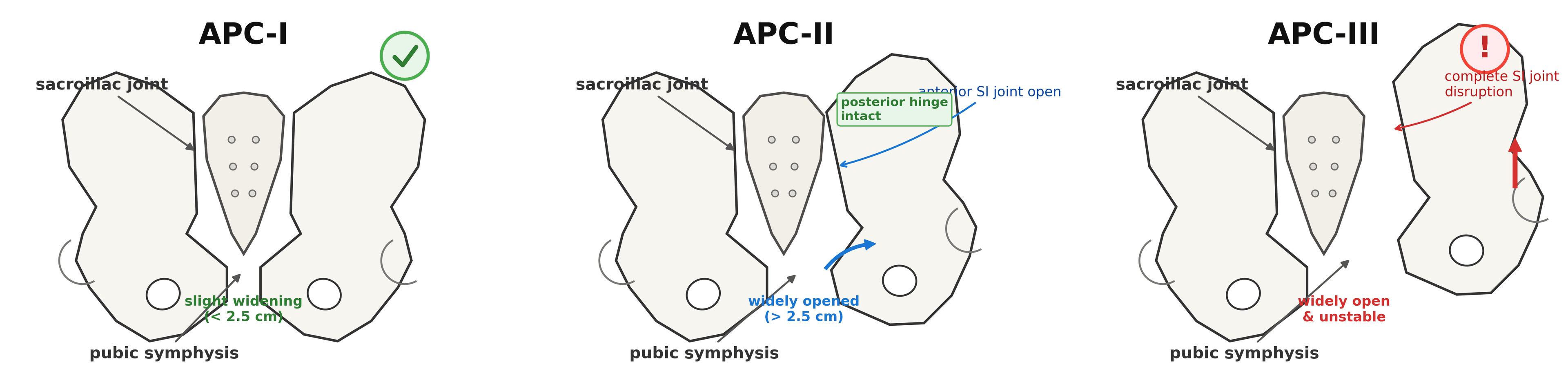 Diagram of the three Young-Burgess APC grades showing progressive symphysis widening and sacroiliac disruption