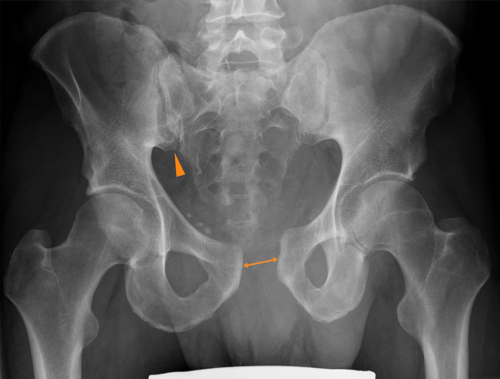 AP pelvis X-ray showing open book pelvic injury with annotations