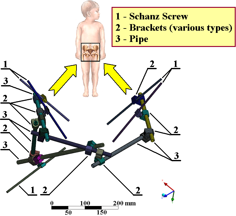 External fixator diagram for pelvic fracture stabilization