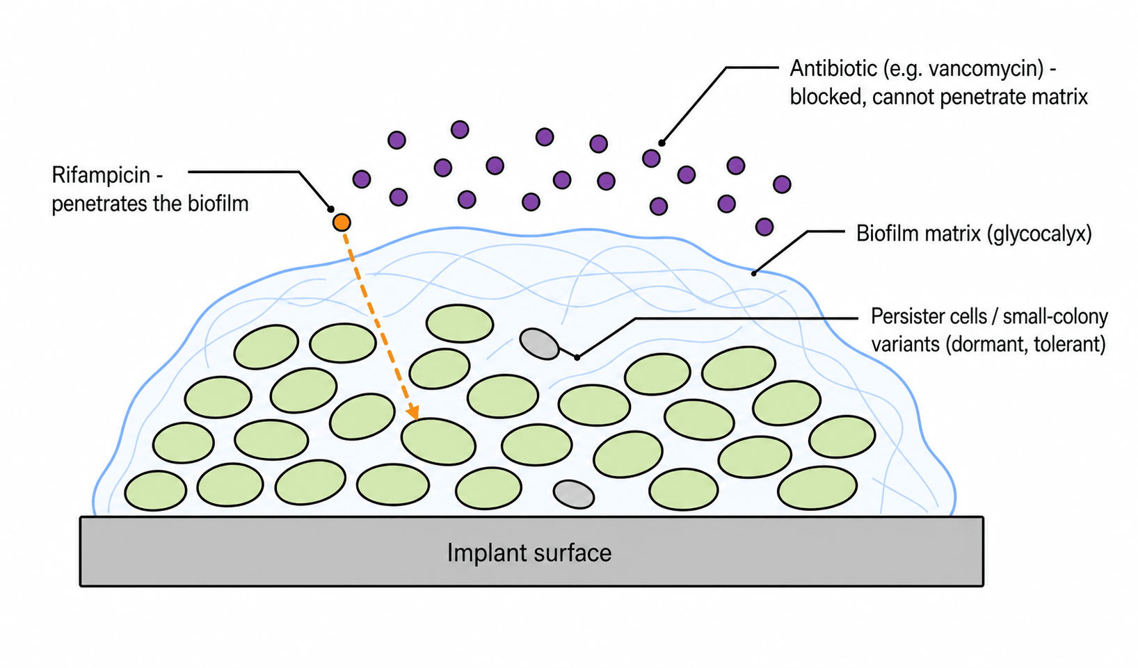 Diagram of a biofilm on an implant surface showing bacteria, persister cells, blocked antibiotic penetration and rifampicin penetrating the matrix