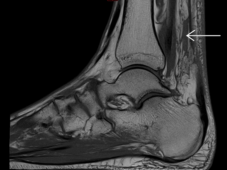 MRI of Achilles tendon rupture after fluoroquinolone exposure