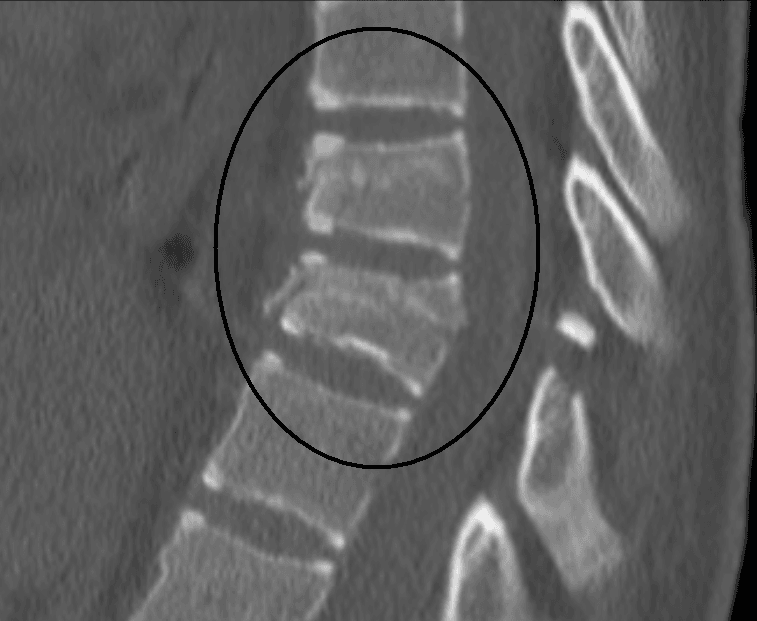 Sagittal CT of the thoracic spine showing a circled horizontal Chance (flexion-distraction) fracture at T9-T10, a Type B tension-band injury.