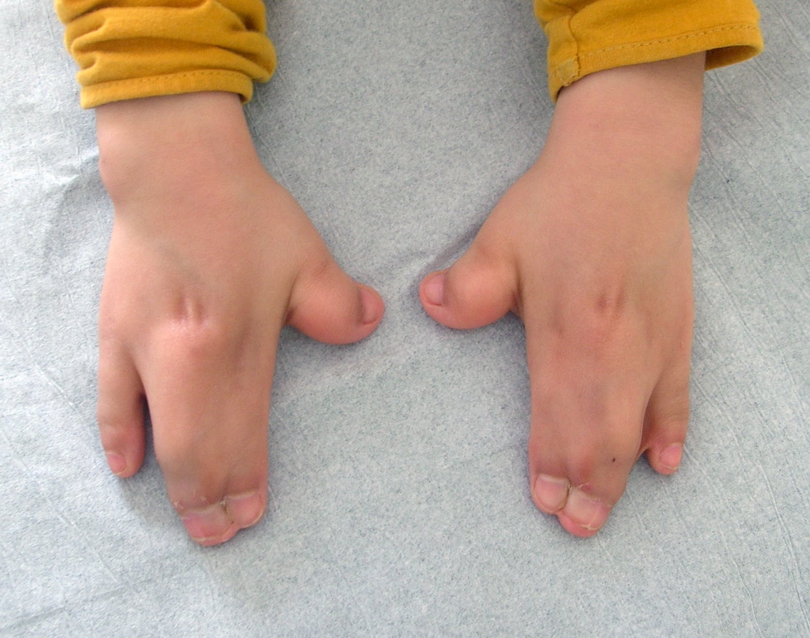 Dorsal view of bilateral Apert hands with separate thumbs and border digits