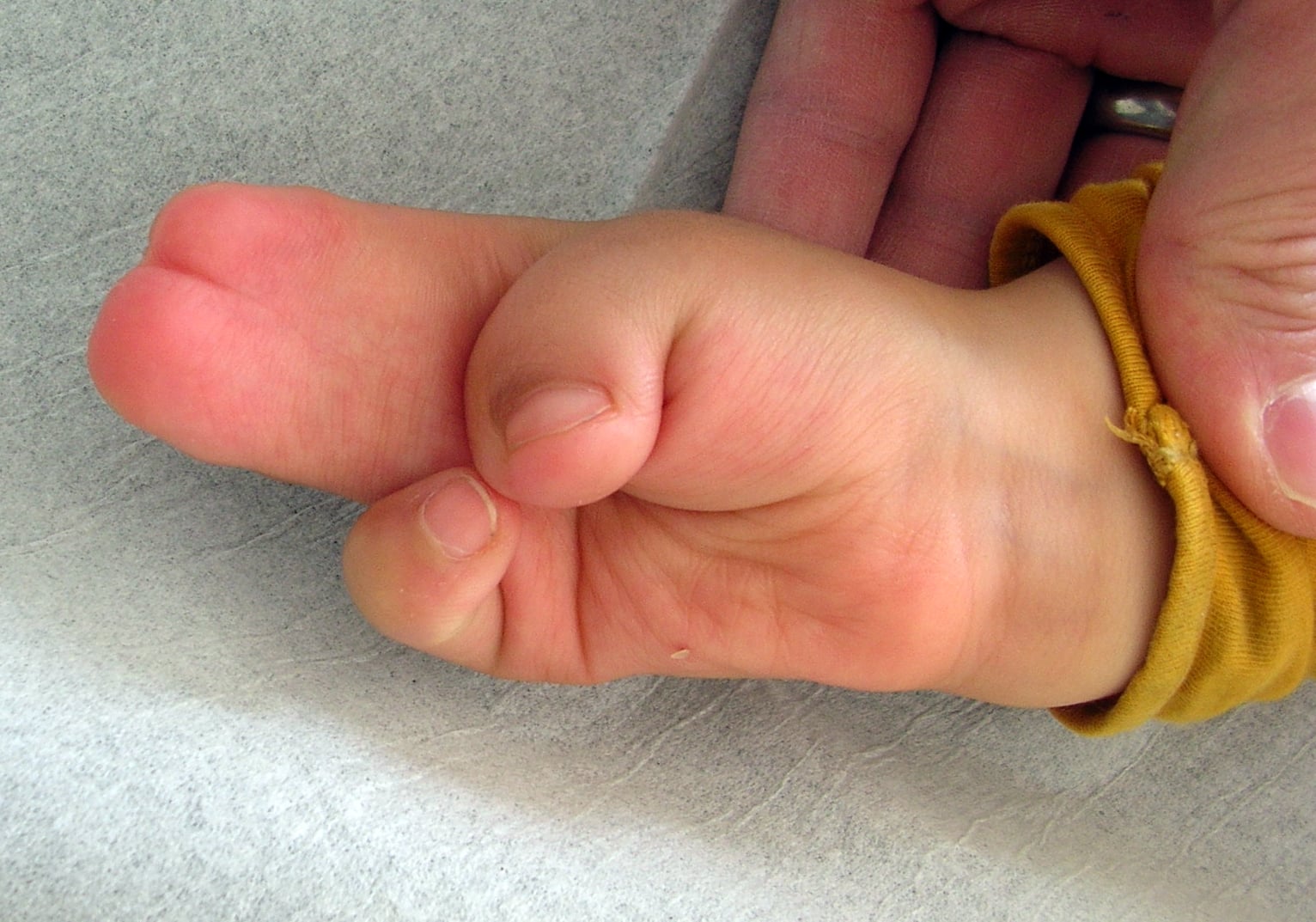 Oblique palmar view of an Apert hand showing the conjoined central digit mass