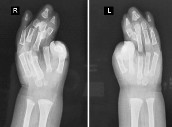 Bilateral hand radiographs showing severe phalangeal and metacarpal synostosis in Apert syndrome