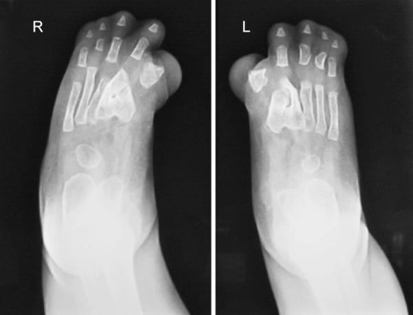Bilateral foot radiographs showing metatarsal and phalangeal fusion in Apert syndrome