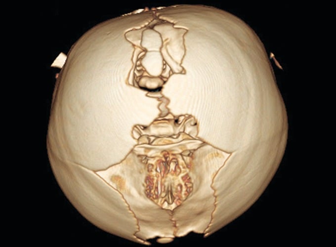 Three-dimensional cranial CT showing the characteristic midline calvarial defect in Apert syndrome