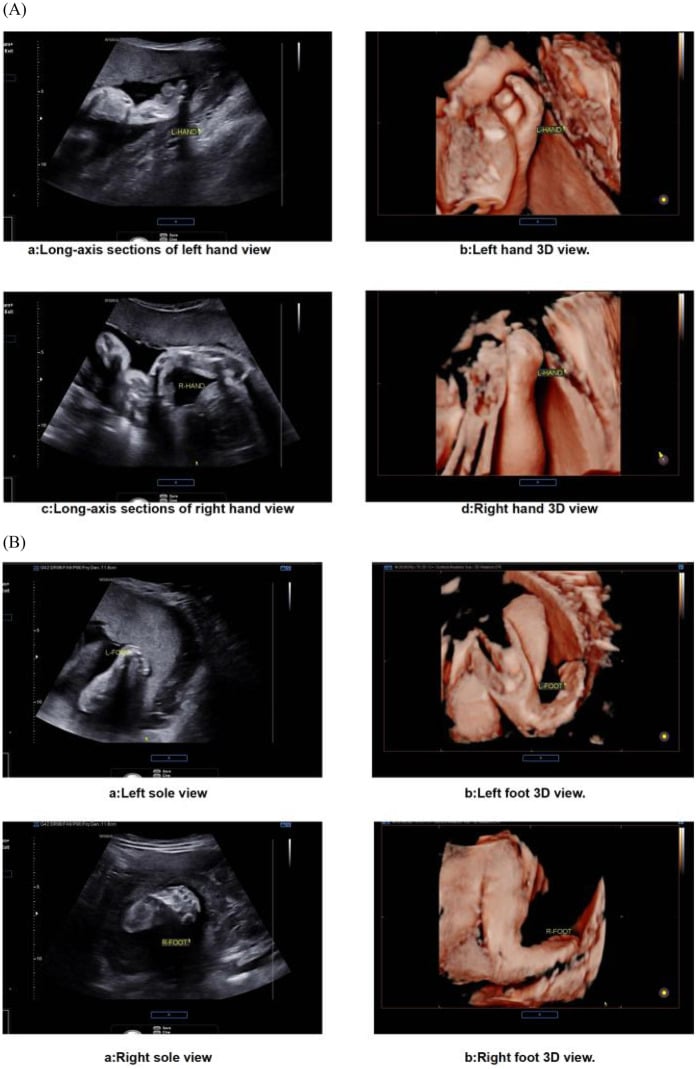 Two-dimensional and three-dimensional prenatal ultrasound of Apert hands and feet