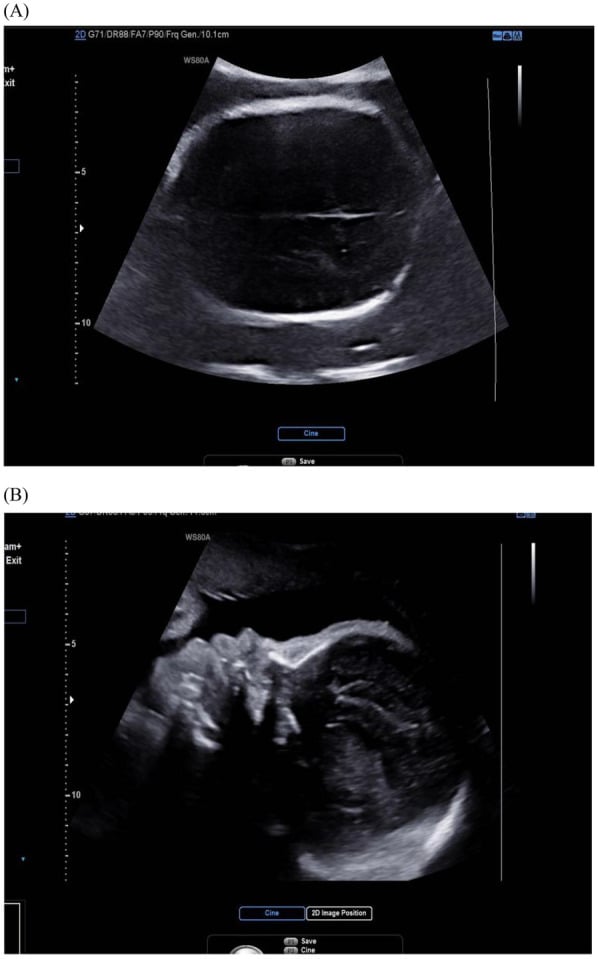 Prenatal ultrasound showing coronal-suture closure and abnormal cranial profile in Apert syndrome