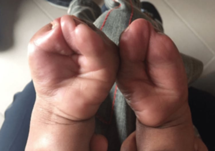 Palmar view of bilateral severe mitten hands in Apert syndrome