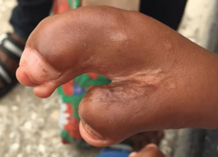 Apert hand after first-stage thumb–index web-space release