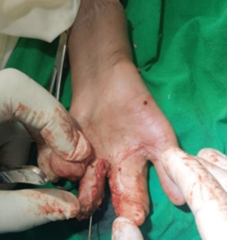 Operative creation of the second web space during staged Apert hand reconstruction