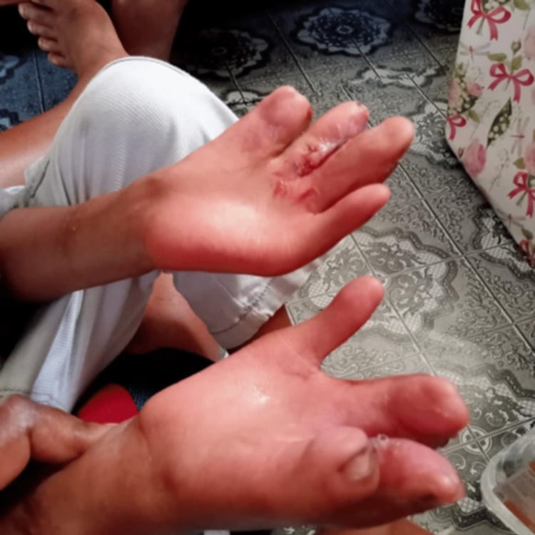 Bilateral Apert hands after completion of staged digital separation