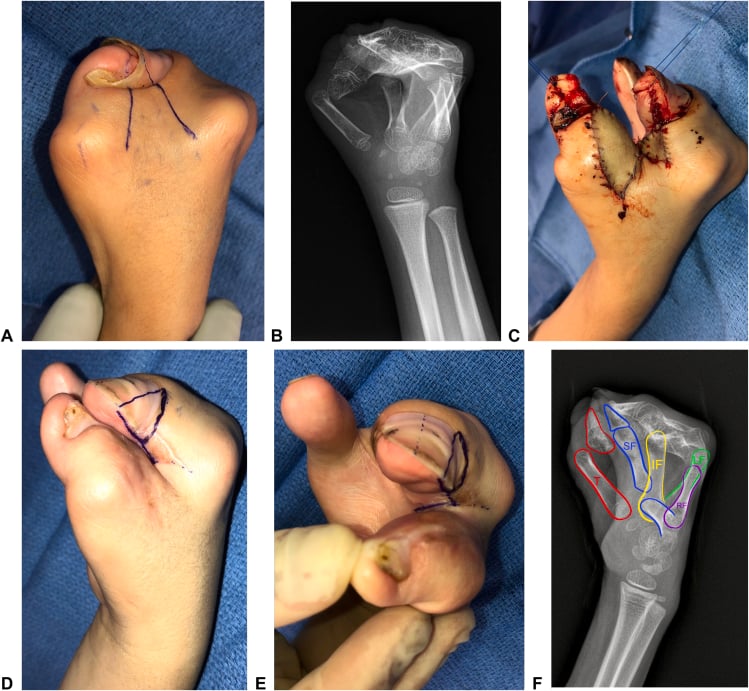 Upton type-three Apert hand with radiographic mapping and revision first-web reconstruction