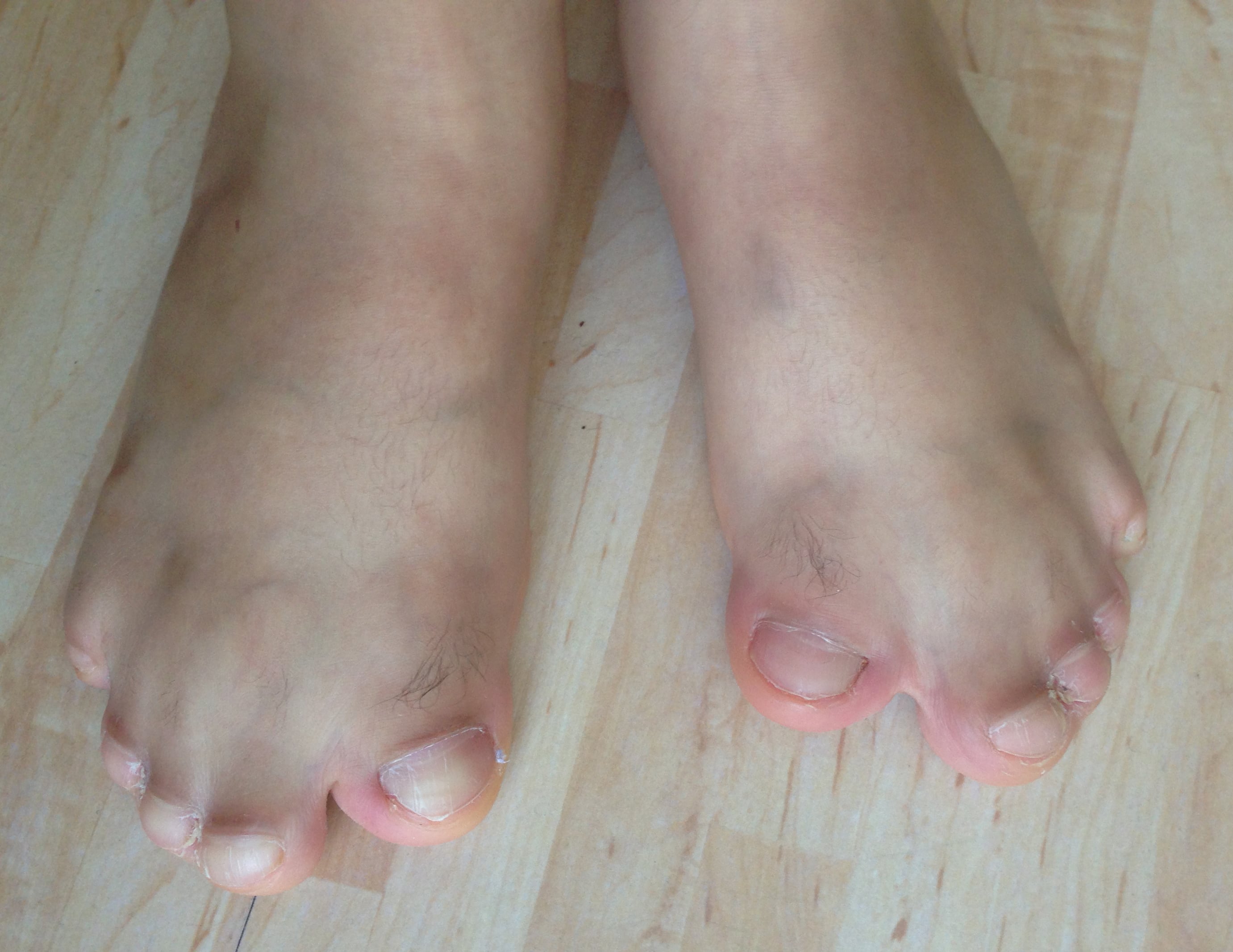 Dorsal view of Apert feet with broad great toes and complex toe syndactyly