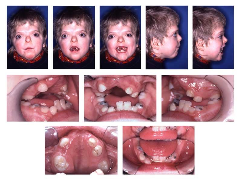 Composite clinical photographs of a child with Apert syndrome showing facial and intraoral features