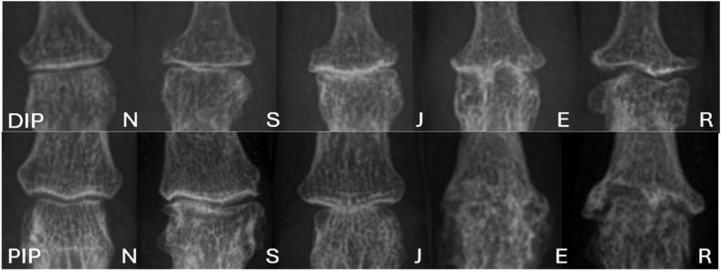 Sequential radiographic comparison of interphalangeal joints in osteoarthritis, erosive OA, and RA