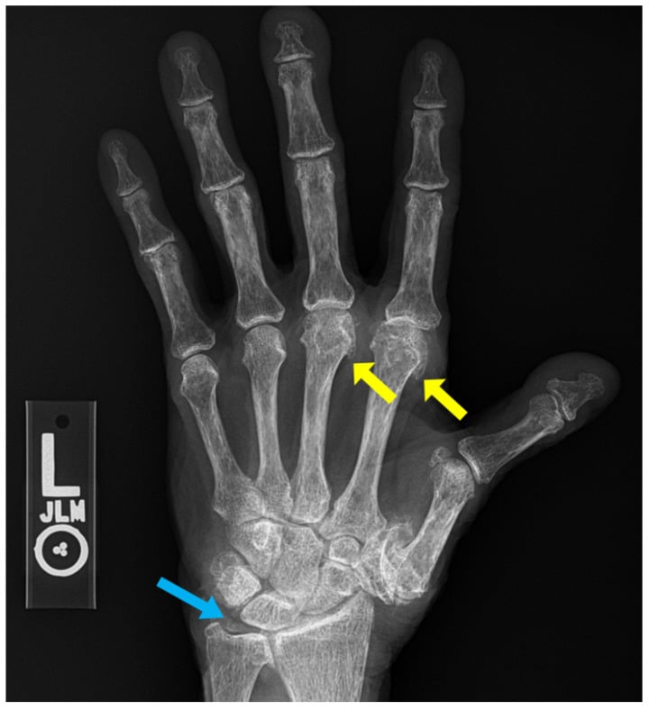 Hand radiograph showing CPPD chondrocalcinosis and hook osteophytes
