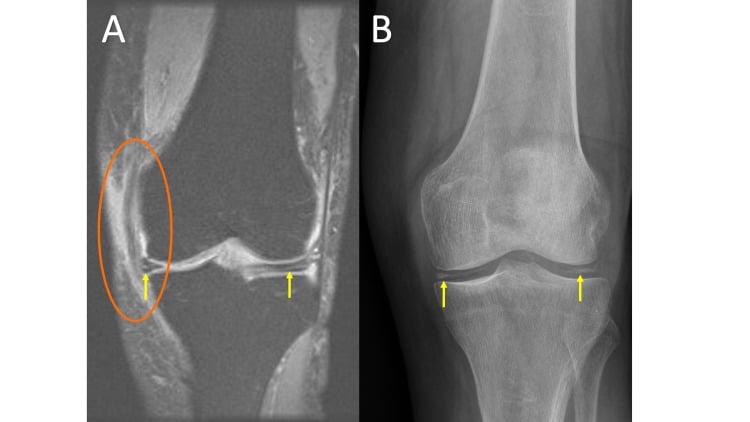 Knee MRI and radiograph showing CPPD meniscal chondrocalcinosis